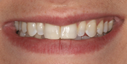 Before Image: Case 126 - front