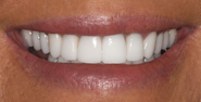 After Image: Case 127 - front