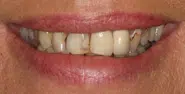 Before Image: Case 127 - front