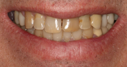 Before Image: Case 128 - front