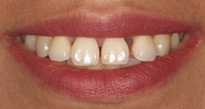 Before Image: Case 130 - front