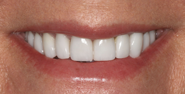 After Image: Case 131 - front
