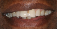 Before Image: Case 132 - front