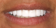 After Image: Case 133 - front