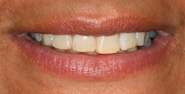 Before Image: Case 133 - front