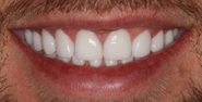 After Image: Case 136 - front