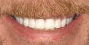 After Image: Case 137 - front