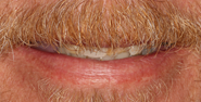 Before Image: Case 137 - front