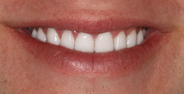 After Image: Case 138 - front