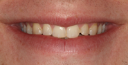 Before Image: Case 138 - front