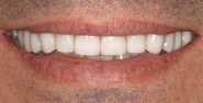 After Image: Case 139 - front