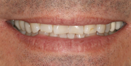 Before Image: Case 139 - front