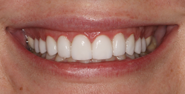 After Image: Case 140 - front