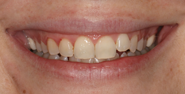 Before Image: Case 140 - front