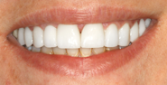 After Image: Case 141 - front