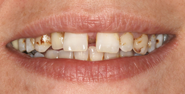 Before Image: Case 141 - front