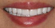 After Image: Case 142 - front