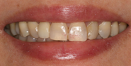 Before Image: Case 142 - front