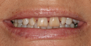 Before Image: Case 143 - front