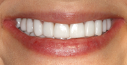 After Image: Case 144 - front