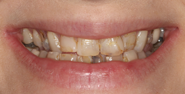 Before Image: Case 144 - front
