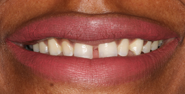 Before Image: Case 145 - front