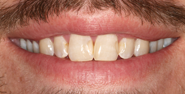 Before Image: Case 146 - front