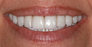 After Image: Case 147 - front