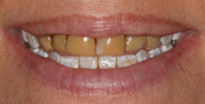 Before Image: Case 147 - front