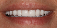 After Image: Case 148 - front