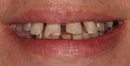 Before Image: Case 148 - front