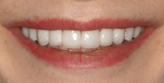 After Image: Case 149 - front