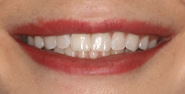 Before Image: Case 149 - front