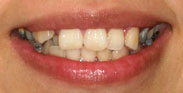 Before Image: Case 15 - front
