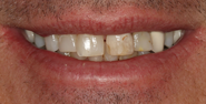 Before Image: Case 151 - front