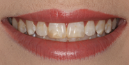 Before Image: Case 152 - front