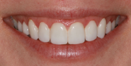 After Image: Case 153 - front