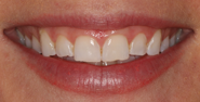 Before Image: Case 153 - front