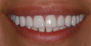 After Image: Case 154 - front