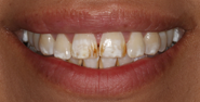 Before Image: Case 154 - front