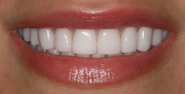 After Image: Case 155 - front