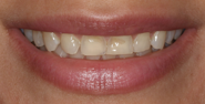 Before Image: Case 155 - front
