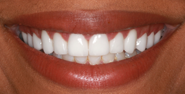After Image: Case 156 - front