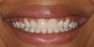 Before Image: Case 156 - front