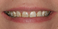 Before Image: Case 157 - front