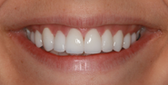 After Image: Case 158 - front