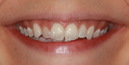 Before Image: Case 158 - front