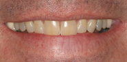 Before Image: Case 159 - front