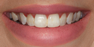 Before Image: Case 160 - front