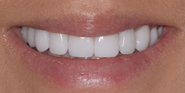 After Image: Case 161 - front